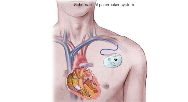 Heart-Powered Pacemaker