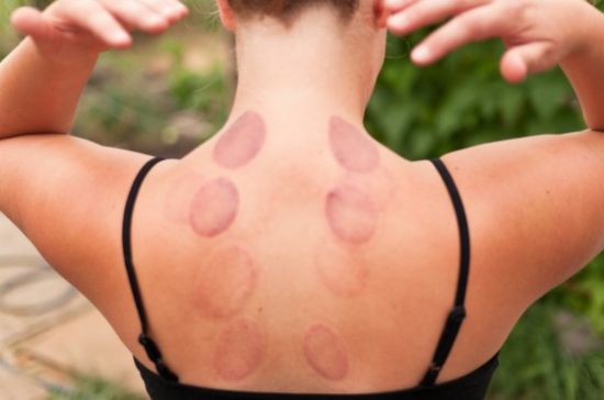 wet cupping