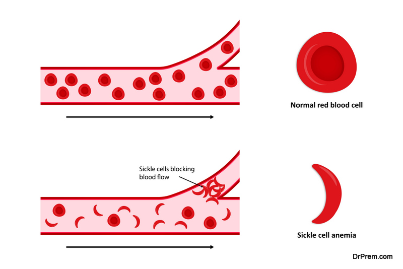 Ways to Treat Sickle Cell Disease